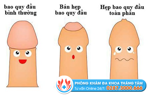 Hẹp bao quy đầu ở nam giới 