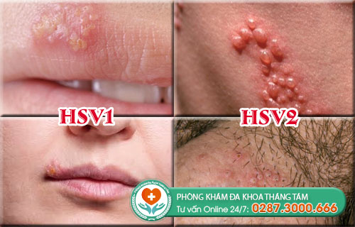 Hình ảnh triệu chứng bệnh herpes