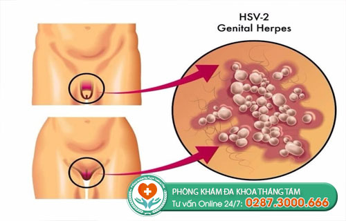Hình ảnh virus HSV2 ở bộ phận sinh dục