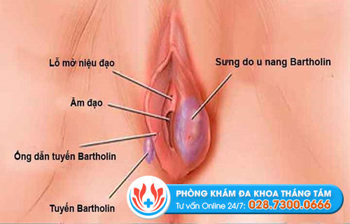 Hình ảnh viêm tuyến bartholin ở nữ giới