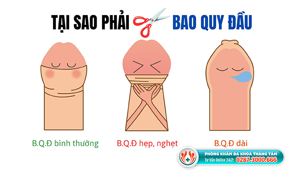 Cắt bao quy đầu ở đâu tại Gò Vấp?