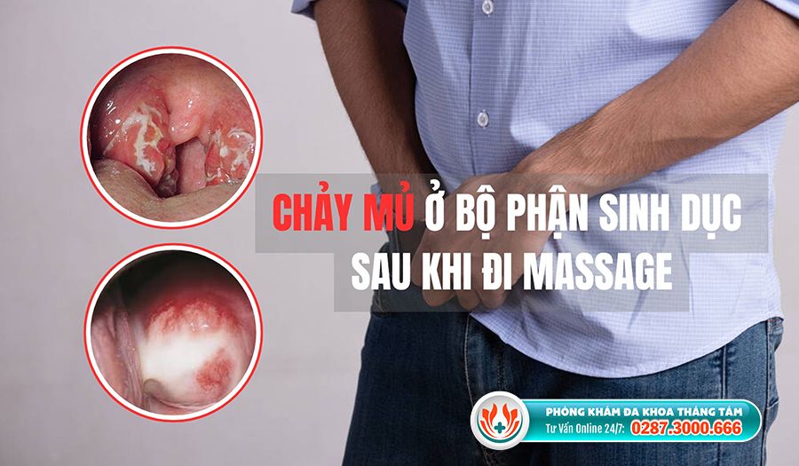 Chảy mủ ở dương vật sau khi đi massage là dấu hiệu cần khám ngay