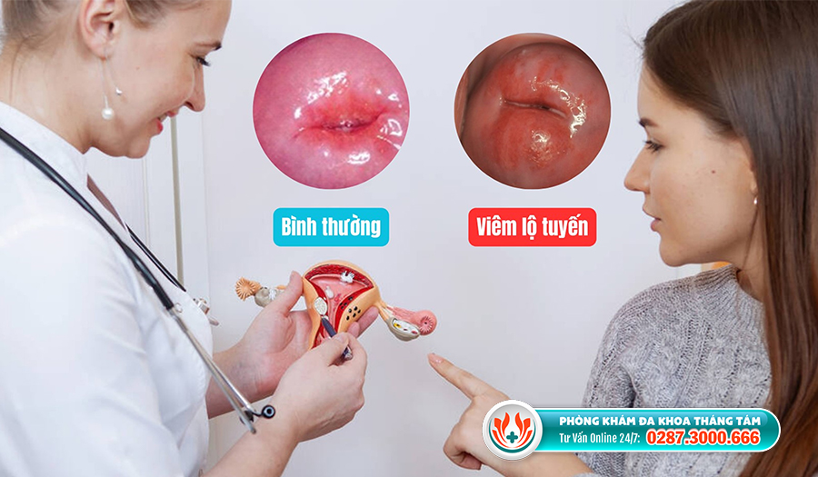 Mẹo vặt làm đẹp: Chi phí đốt viêm lộ tuyến cổ tử cung ở TPHCM là bao nhiêu? Chi-phi-dot-viem-lo-tuyen-co-tu-cung-o-tphcm