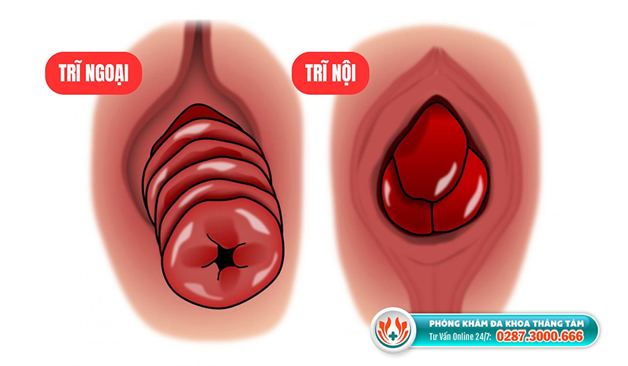 Nhận biết dấu hiệu của bệnh trĩ