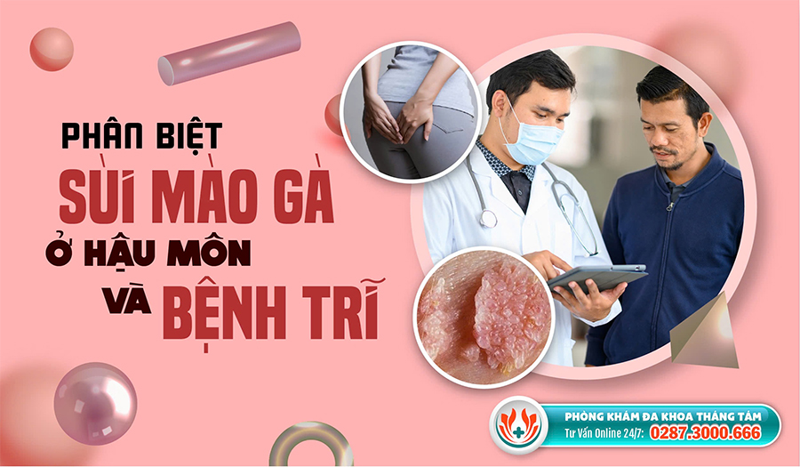 Mẹo vặt làm đẹp: Sùi mào gà ở hậu môn và bệnh trĩ làm sao để phân biệt? Phan-biet-sui-mao-ga-o-hau-mon-va-benh-tri