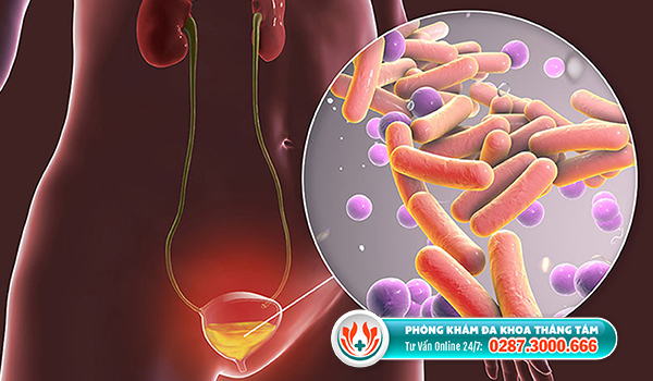 Vi khuẩn Escherichia Coli - Tác nhân gây viêm đường tiết niệu ở nam giới
