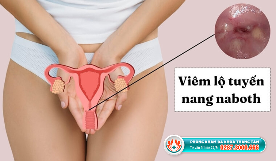 Nơi điều trị nang Naboth ở TPHCM uy tín bạn nên biết